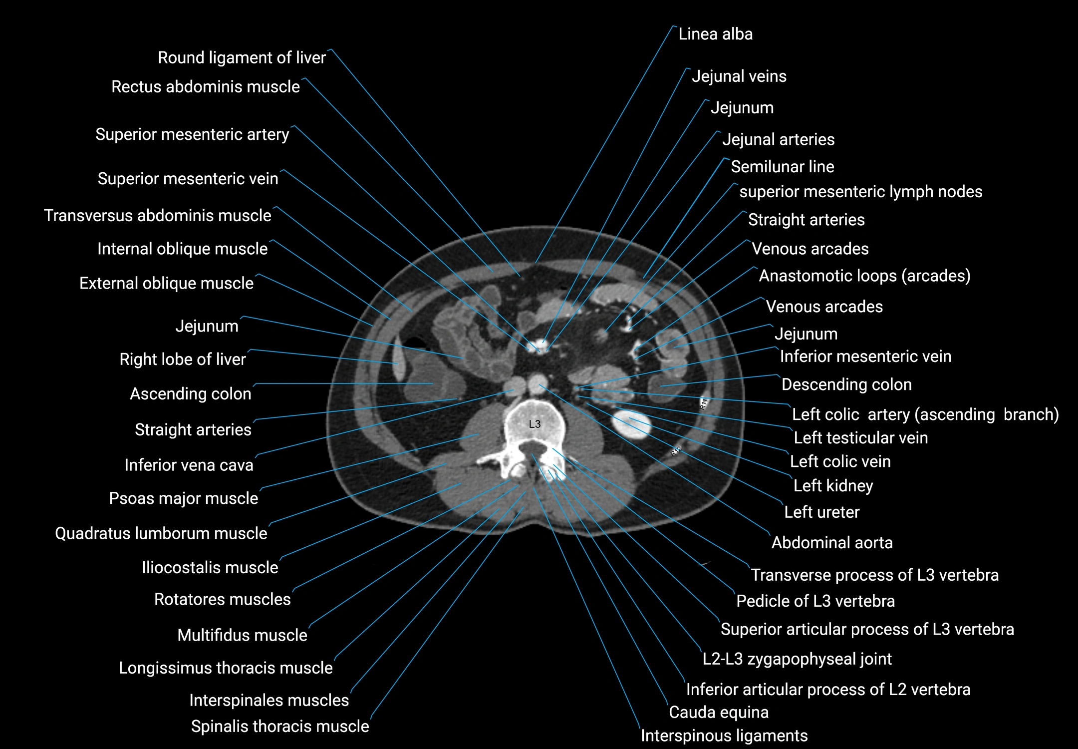 CT male pelvis axial cross sectional anatomy labelled radiology image -00088.webp